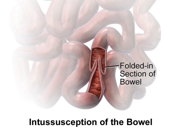 intussusception