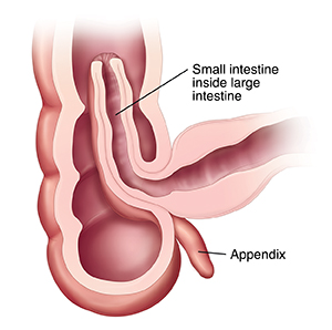  intussusception