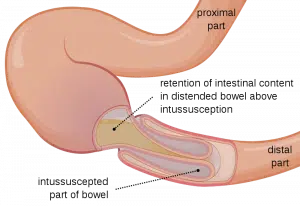 intussusception